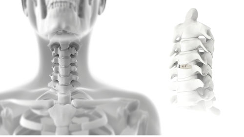 Caja intersomática cervical - FIX-C - Jeil Medical Corporation - vía anterior / de PEEK