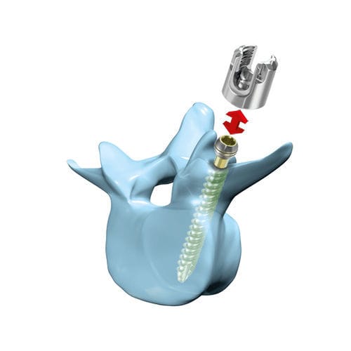 Tornillo pedicular lumbar - “mediRod®”-Tri - Medicon eG - poliaxial / canulado