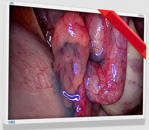 Monitor médico - EndoVue Plus - NDS Surgical Imaging - para endoscopia / de alta definición / 55"