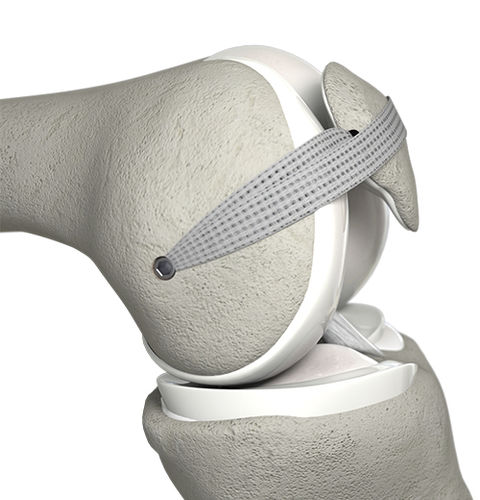 Prótesis de ligamento ligamento femoropatelar - MPFL™ - Neoligaments - sintética