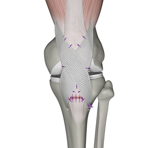 Prótesis de ligamento tendón cuadricipital - QuadsTape ™ - Neoligaments - sintética