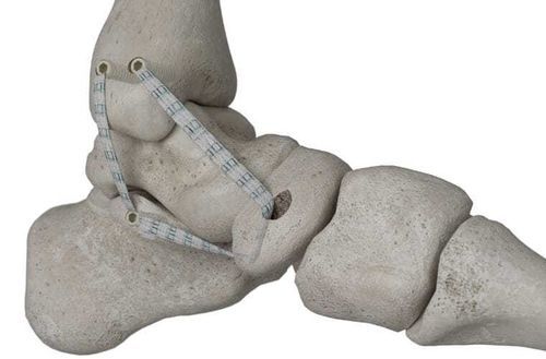 Prótesis de ligamento tendón tibial posterior - Infinity-Lock&reg; - Neoligaments - sintética