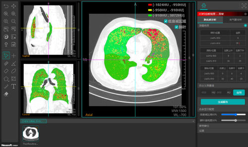 Software de visualización - NeuLungCARE - Neusoft Medical Systems  - de análisis / de CAD / de medición