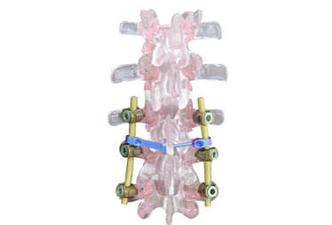 Sistema de osteosíntesis cervicotorácico y sacrolumbar - EVOLUTION PLUS - Ortosintese - vía posterior / para adulto