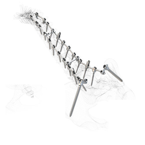 Tornillo pedicular poliaxial - WSI MX/PX®  - Peter Brehm - monoaxial / metálico
