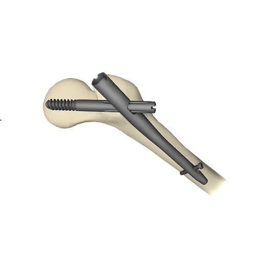 Clavo intramedular para fémur - Gamma3 - Stryker - para trocánter / fijación proximal / de titanio