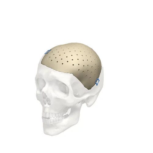 Implante craneal a medida - Cranial iD - Stryker
