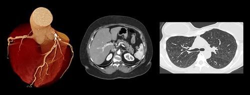 Software médico - PIQE - Canon Medical Systems Europe - TDM / de visualización / de diagnóstico