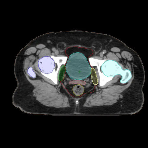 Plataforma de IA médica - Varian Oncology - de contorneo / de planificación de tratamiento