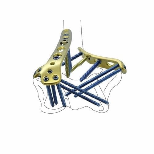 Placa de compresión para húmero - Double Medical Technology - porción distal / porción medial / bloqueada