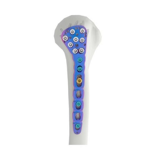 Placa de compresión para húmero - VAL - Double Medical Technology - porción proximal / bloqueada
