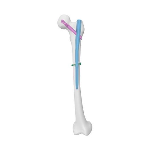 Clavo intramedular para fémur - APFN Aimstrong - Double Medical Technology - fijación proximal / fijación diafisaria / de acero inoxidable