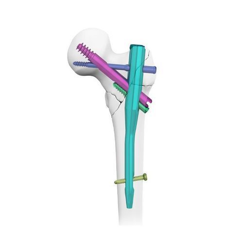 Clavo intramedular para fémur - Double Medical Technology - fijación proximal