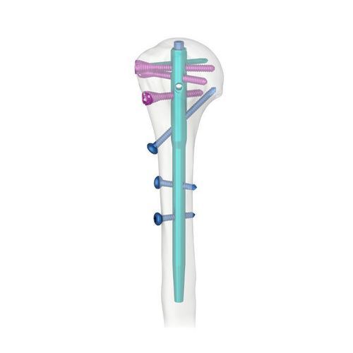 Clavo intramedular para húmero - AHN - Double Medical Technology - fijación proximal / derecho / izquierdo