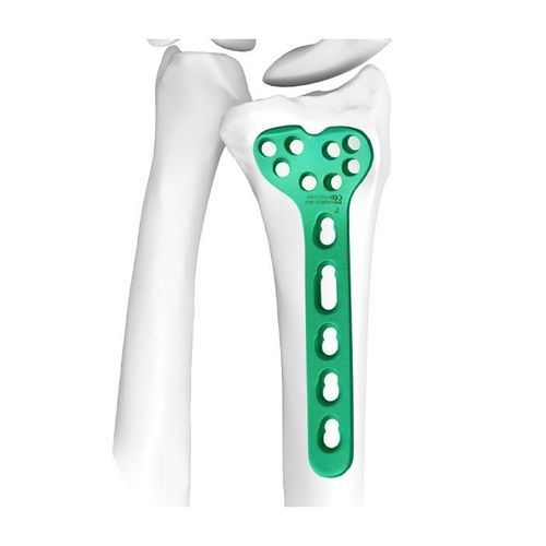 Placa de osteotomía para radio - Double Medical Technology - porción distal / bloqueada / de titanio