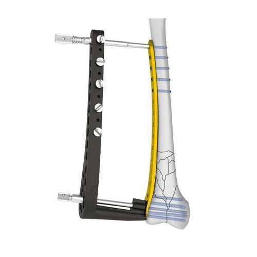 Placa de osteotomía para fémur - Double Medical Technology - porción distal / bloqueada