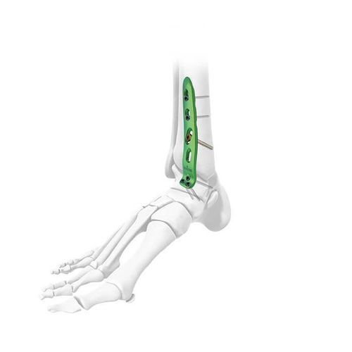 Placa de artrodesis para tobillo - Double Medical Technology - lateral / anterolateral / bloqueada