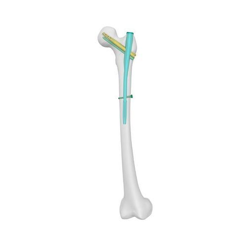 Clavo intramedular para fémur - PFCN - Double Medical Technology - fijación proximal