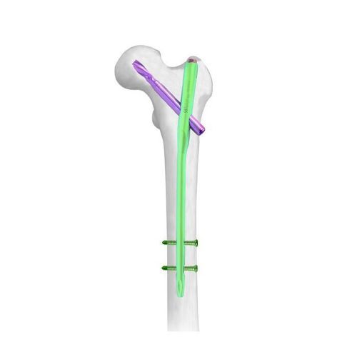 Clavo intramedular para trocánter - PFNA - Double Medical Technology - para fémur / fijación proximal / fijación distal