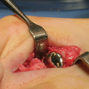 Implante interfalángico del pie - HemiCAP DF®  - Arthrosurface