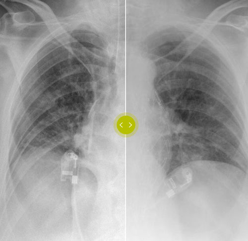 Algoritmo de adquisición - SkyFlow Plus - Philips Healthcare - de simulación / de aprendizaje automático / de radiografía