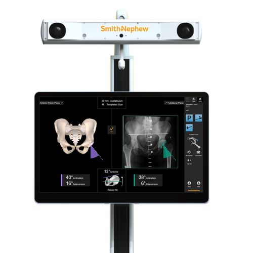 Sistema de navegación quirúrgica para la colocación de prótesis de cadera - RI - Smith & Nephew - óptico