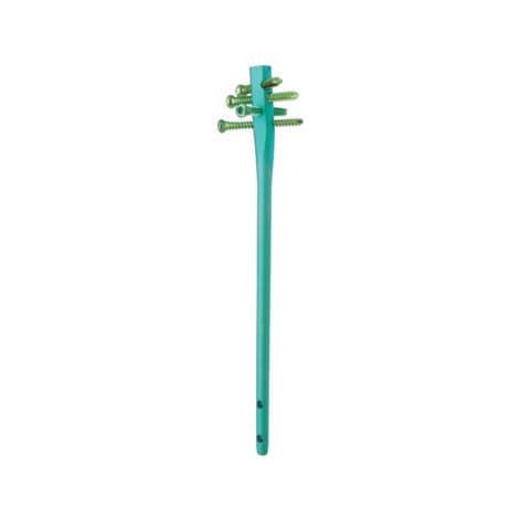 Clavo intramedular para húmero - TRIGEN™ - Smith & Nephew - fijación proximal / fijación distal / metálico