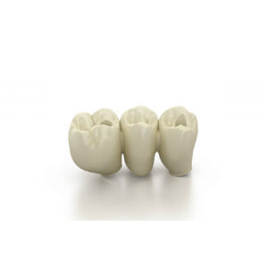 Puente dental forma anatómica - ANTHOGYR  