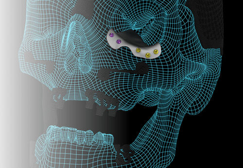 Implante periorbital a medida - ORBIT - A.B. Dental Devices