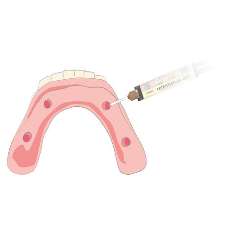 Adhesivo dental para sistema de implante - retention.sil  - bredent medical - para prótesis dentales
