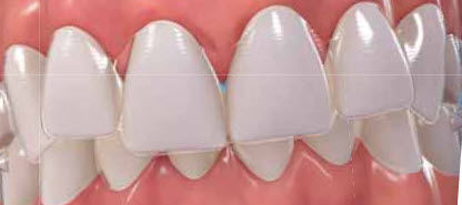 Aparato miofuncional - Invisalign - Align Technology