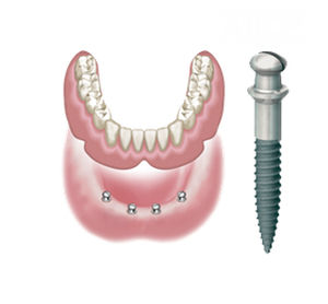 Implante dental cónico - ATLAS  - DENTATUS AB   - de titanio / externo / 1 fase