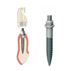 Implante dental cónico - ANEW  - DENTATUS AB   - de titanio / externo / estrecho