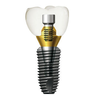 Implante dental cónico - SuperLine - Dentium - de titanio / hexágono interno