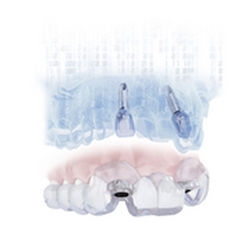 Software de simulación de implante dental - SIMPLANT® - DENTSPLY Implants GmbH - de planificación / de implantología dental