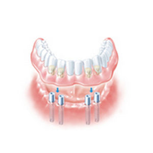 Pilar para implante recto - ANKYLOS® SynCone® - DENTSPLY Implants GmbH