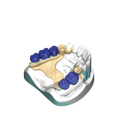 Módulo de software de diseño - PartialCAD - exocad GmbH   - de impresión / de laboratorio dental / de dentadura