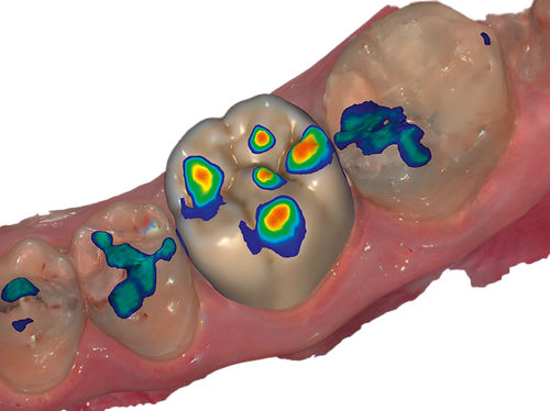Módulo de software de captura - Auto Articulator  - exocad GmbH   - de diseño / para odontología / para odontología