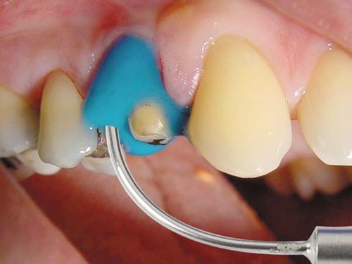 Material dental de alginato - Algiloid® - Hager & Werken - para puente dental / para corona / para inlays dentales