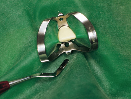 Grapa para dique de goma - 355335 - Hager & Werken