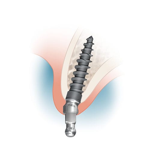Implante dental de titanio - MDL2513A, MDL2515A, MDL2518A - Intra-Lock International, Inc.   - tipo bola / en ángulo