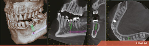 Software para imagen dental - i-Dixel 2.0 - Morita