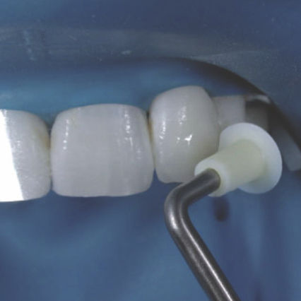 Instrumento de esculpido para composite dental - NA067 - Navadha Enterprises  