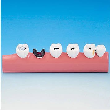 Modelo anatómico para odontología - PE-TDS005 - Nissin Dental Products Inc.   - de formación / de caries