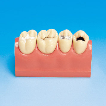 Modelo anatómico para odontología - PE-STP007 - Nissin Dental Products Inc.   - de formación / de caries