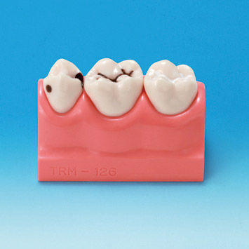 Modelo anatómico para odontología - PE-STP008 - Nissin Dental Products Inc.   - de formación / de caries