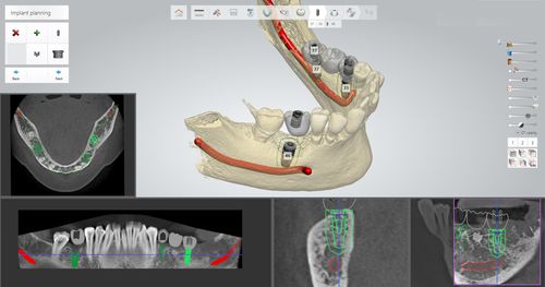 Software de planificación - Thommen Medical AG   - para cirugía guiada / de implantología dental