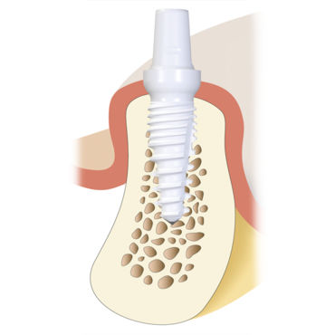 Implante dental cónico - Z5m(t) - Z-Systems AG   - de cerámica / de una pieza / autorroscable