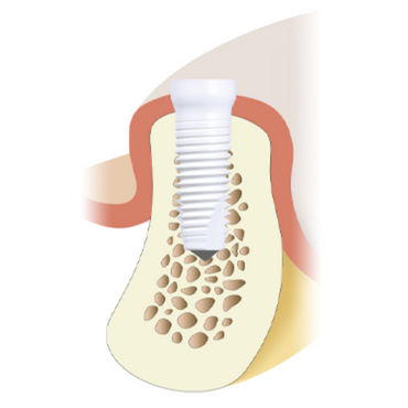 Implante dental cilíndrico - Z5-TL - Z-Systems AG   - de cerámica / interno / recto