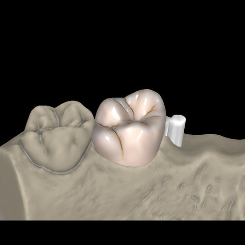 Módulo de software de CAD - Attachments - Zirkonzahn - FAO / para fabricación de prótesis / de laboratorio dental